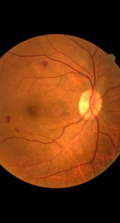 Лечение диабетической ретинопатии